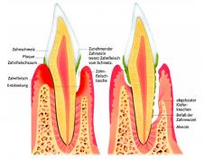 Zahnstein, Parodontitis
