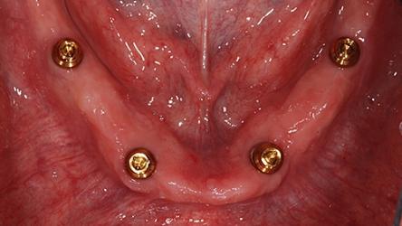 Unterkiefer mit Implantaten