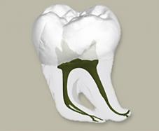 Schema Wurzelbehandlung